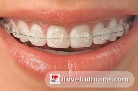 Ceramic Braces