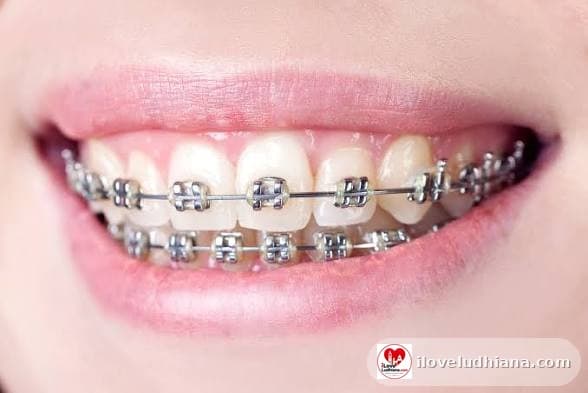 Metal Braces