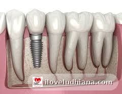 Dental Implants